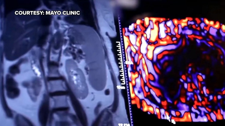 Healthy SA: Battling liver cancer, a disease which often has no symptoms early on — KENS 5 (San Antonio), Palo Alto Health news